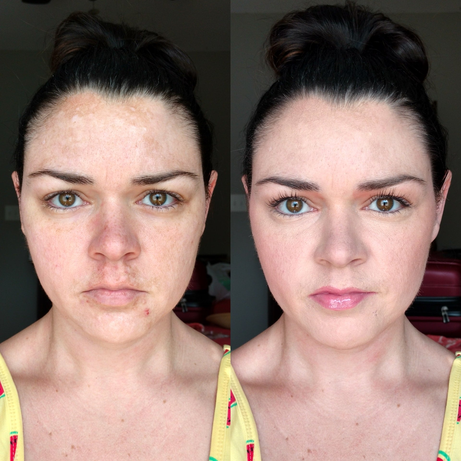 Using Concealer to Cover Melasma