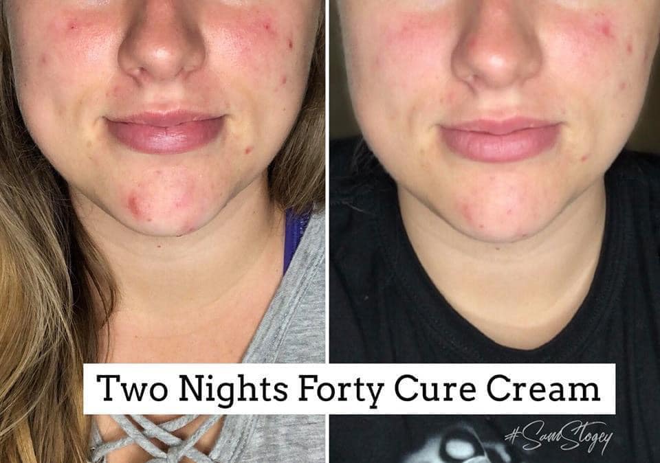 Forty Cure Cream Acne healing