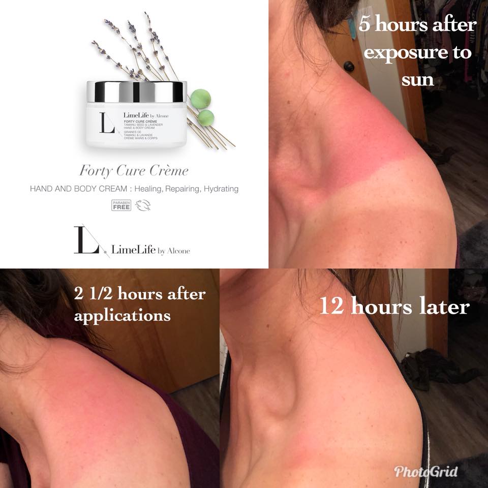 Forty Cure Cream Sunburn before and after 12 hours